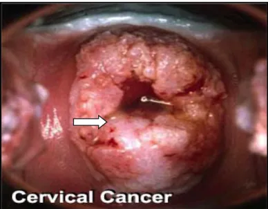 Figura 1: Foto de colposcopia realizada em paciente portadora de lesão neoplásica  em colo de útero apresentando sangramento (seta)
