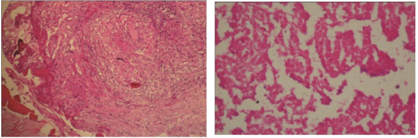 Foto  5  -  Granuloma  epitelioide  em  linfonodo  (Caso  nº  47,  HE,  aumento  original  200x