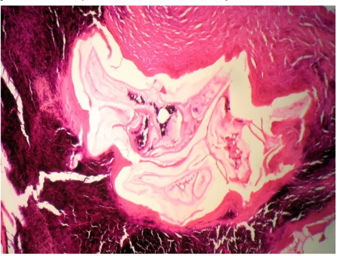 Figura  7,  fotomicrografia  2-  Observar  no  centro  dos  granulomas,  calcificações  grosseiras  (áreas  mais  escurecidas)  e  no  meio  a  membrana  laminada  com  seu  aspecto  cerebróide