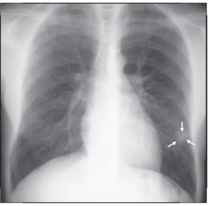 Figura 16  –  Nódulo circunscrito no lobo inferior esquerdo (setas). Radiograficamente                     os tuberculomas podem simular carcinoma broncogênico