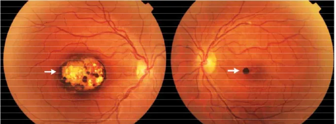 FIGURA  5.  Lesão  corrioretiniana  inativa  causada  pelo  T.  gondii,  localizada  no  olho  direito  do  paciente, com borda hiperpigmentada (seta branca), envolvendo a região macular observada através  de examinação por fundoscopia