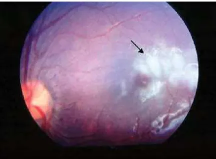 Figura  9.  Branqueamento  ocular  (seta  preta),  causado  por  hipóxia,  em  uma  criança  com  infecção  malárica  por  P