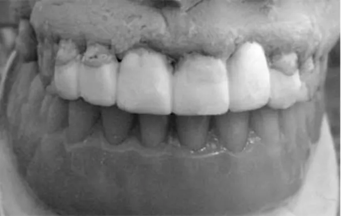 Figure 3. Periapical radiograph of the anterior teeth showing the position  and inclination of each self-threading Minim dentin pin.