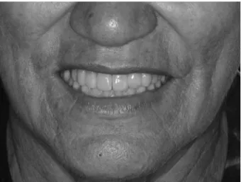 Figure 7. Full-mouth view during the follow-up appointment. No  restoration had failed and the mandibular overdenture was stable.