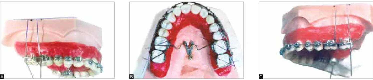 Figure 2 - Final photographs: A) right side, B) occlusal view, C) left side.