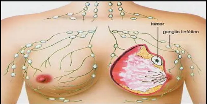Figura 2- Representação de tumor maligno mamário e sua propagação linfática.  