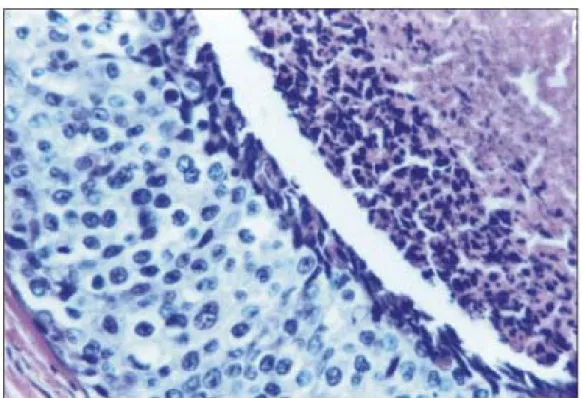 Figura 3 -  Carcinoma in situ do tipo comedo, alto grau nuclear (hematoxilina e 