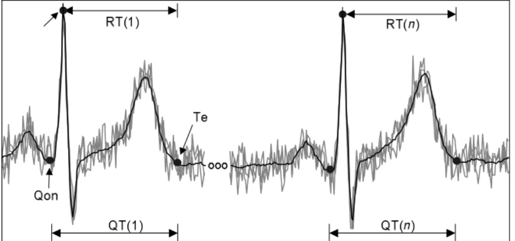 Figura 1.2 - Ruído de banda larga de origem muscular superposto ao sinal de ECG. 