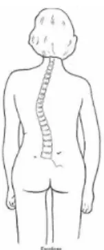 Figura 10 – Escoliose (Verderi, 2008 p.35) 