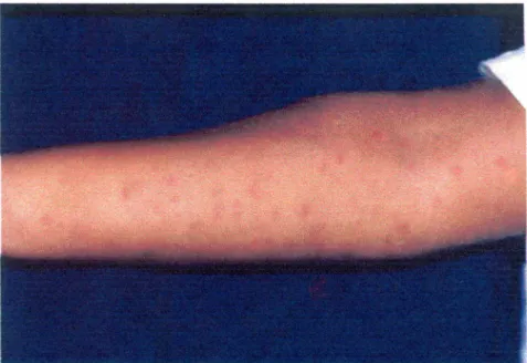 Fig. 9 Fotografia de paciente com ENH antes do tratamento com ciclosporina associada ao corticeide