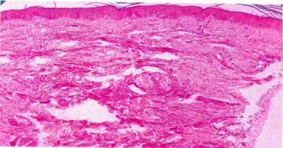 Fig. 11 Fotomicrografia do quadro histol6gico de dermatite granulomatosa do paciente da figura 9 I antes do tratamento com a ciclosporina (aumento de 100X - colora9BO HE)