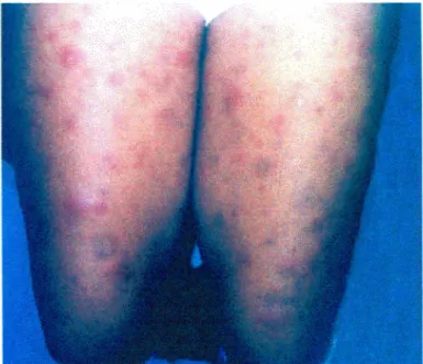Fig. 17 Fotografia de paciente com ENH antes do tratamento com a cidosporina A