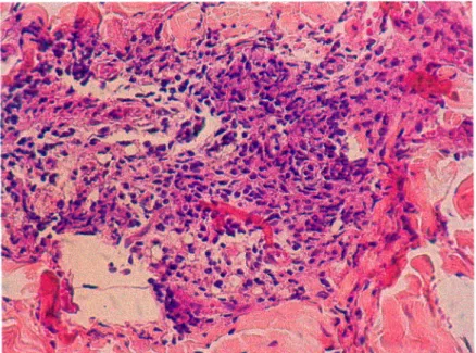 Fig. 20 fotomicrografia do quadro histologico de dermatite fibrosante do paciente da figura 17 apos tratamento com ciclosporina A (aumento 40X - colorav8o HE)