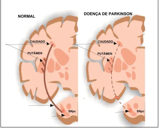 Figura 1: Neuropatologia da doença de Parkinson 