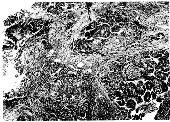Figura 20 - Aspecto panorâmico de micronodulos hepáticos um deles ainda sem atipia, e os demais com transformação neoplásica, circundados por fibrose e infiltrado inflamatório (HE x 40).