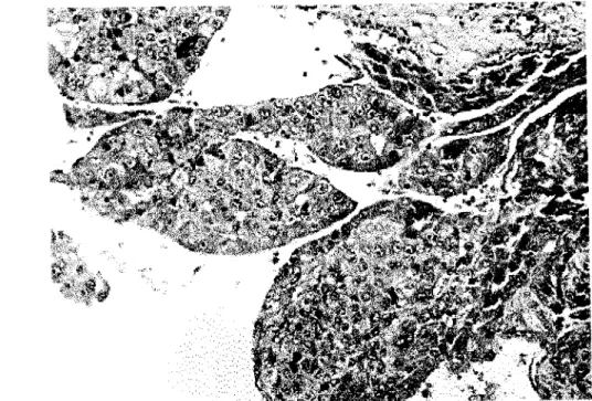 Figura 22 - Maciços e cordões de hepatócitos atípicos configurando o padrão trabecular (HE x 200)