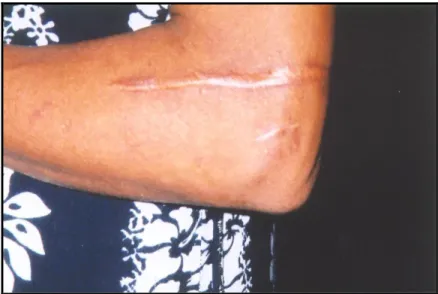 Figura 2: As cicatrizes de Marisa. Foto: Simonian, 2002. 