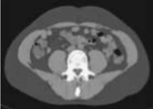 Figura  6.  Tomografia  Computadorizada  de  abdome  evidenciando  depósito  de  gordura  subcutânea