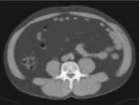 Figura  7.  Tomografia  Computadorizada  de  abdome  evidenciando  depósito  de  gordura  visceral (intra-abdominal)
