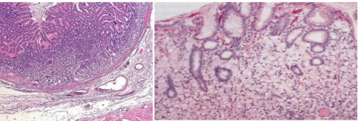 Figura  6  –   Cortes  histopatológicos  de  tecido  gástrico.  À  esquerda  tecido  normal  e  à  direita  adenocarcinoma  gástrico  tipo  difuso,  segundo  classificação de Lauren, 1965 