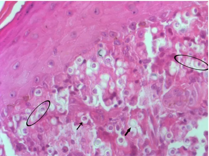 Figura 1: Micrografia da  presença do fungo  Lacazia  loboi  na lesão humana. Intensa presença  do fungo na lesão em formas individual (setas)e catenulada (elipse)