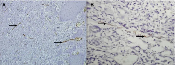 FIGURA  4:  Micrografia  da  marcação  imunohistoquímica  de  vasos  da  microvasculatura  na  lesão  durante  doença  de  Jorge  Lobo
