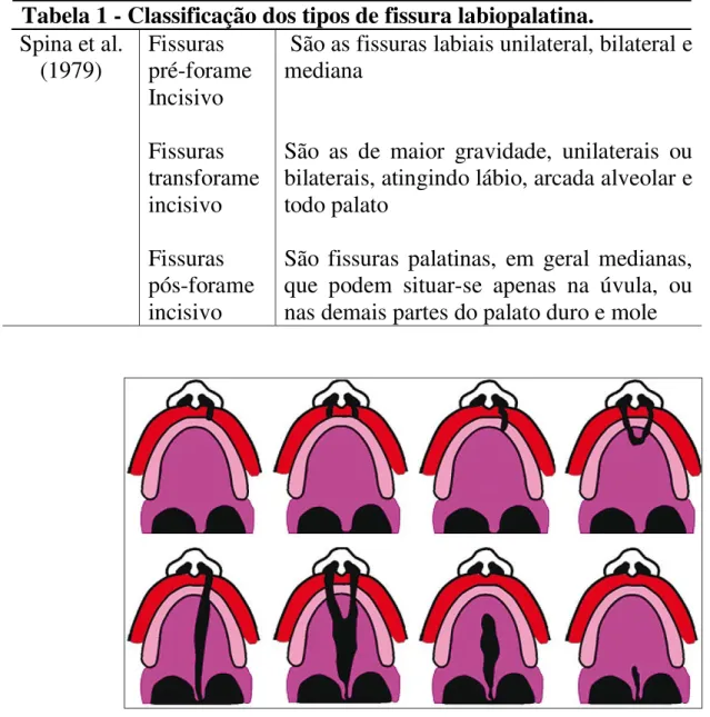 Tabela 1 - Classificação dos tipos de fissura labiopalatina.  Spina et al.  (1979)  Fissuras  pré-forame  Incisivo  Fissuras  transforame  incisivo  Fissuras  pós-forame  incisivo 
