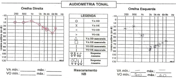 Figura 10: Audiometria Tonal Limiar do paciente 5. 