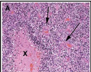 Figura 11: Histopatologia de um caso típico de glioblastoma mostrando tecido tumoral celular glial  com  necrose  central  (x),  com  pseudopalisada  nuclear  perinecrótica  e  proliferação  microvascular  (setas)