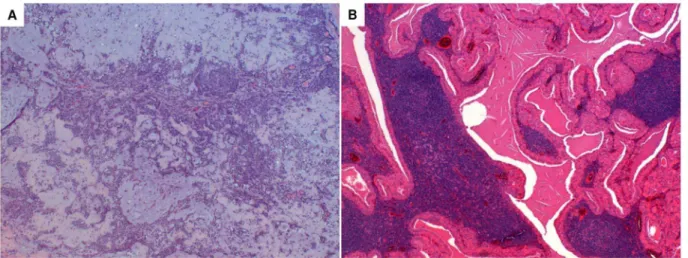 Figure 1. Typical hystological image of PA and WT. The essential components of PA are the capsule, epithelial and myoepithelial cells and mesenchimal or stromal elements