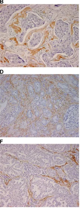 Figure 2. Representative images of periostin expression in normal and tumor tissues. A, normal breast tissue