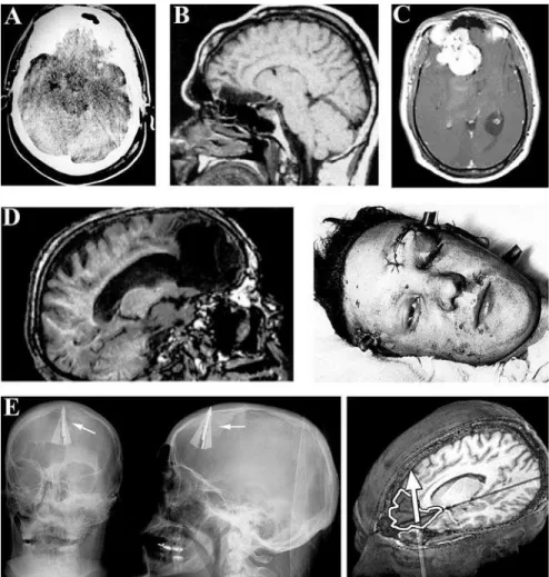Figure 2. Cases Where Brain Anomalies Have, or Have Not, Been Linked to Anti-Social  Behaviour