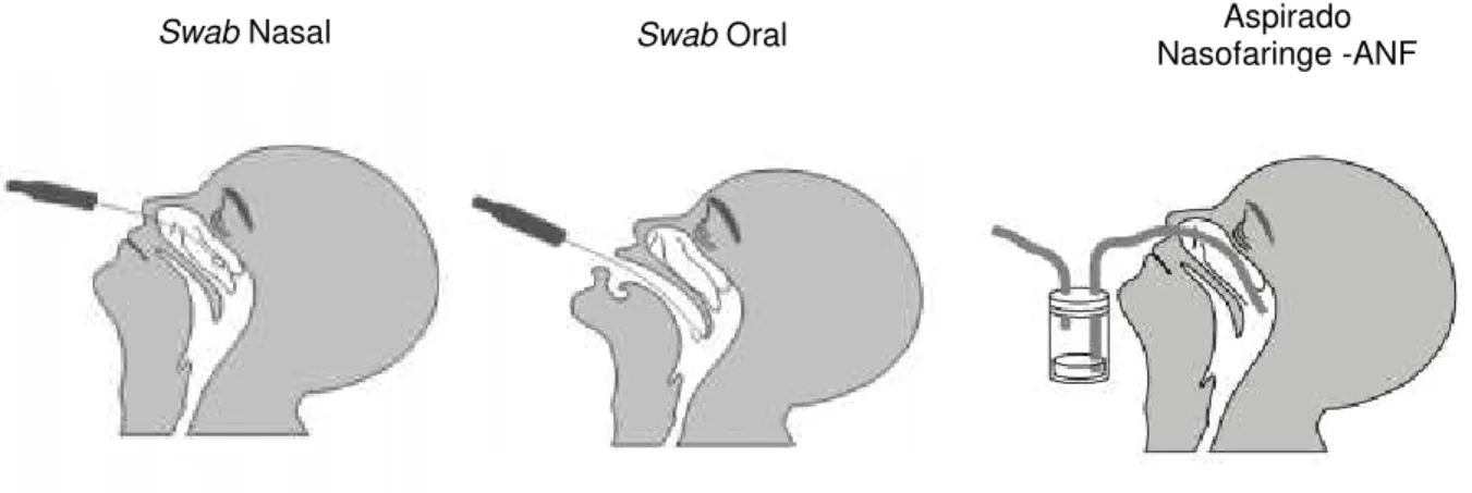 Figura  6:  Figura  esquemática  mostrando  a  coleta  por  Swab  combinado  (Nasal  e  Oral)  e  por  aspirado  Nasofaringe  –   ANF