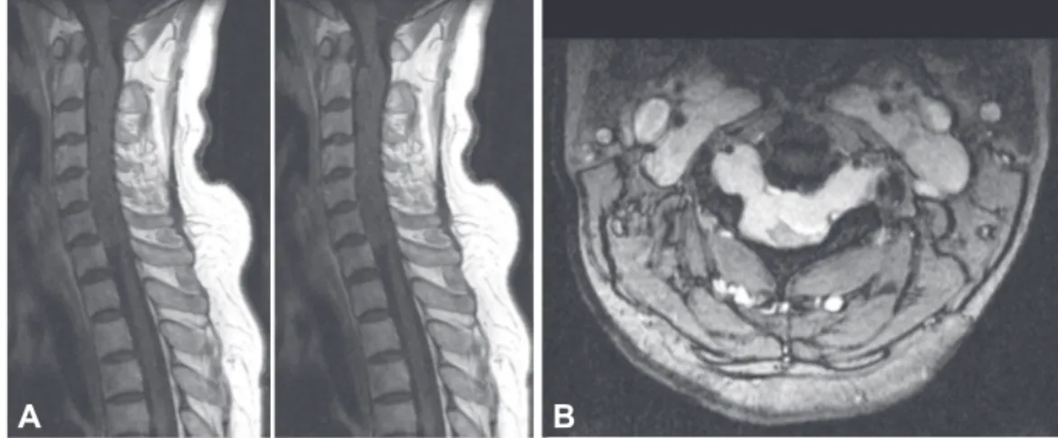Figure 1. Cervical MRI. A: Saggital T1- T1-weighted imaging showing a huge  lobu-lating iso-signal intensity intradural  ex-tramedullary lesion; T2-weighted imaging  in the ventrolateral aspect revealed  het-erogeneous high signal intensity lesion,  that w
