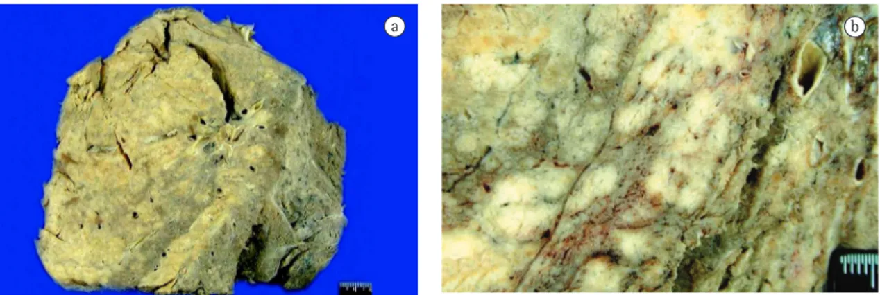 Figure 1 - Macroscopic aspects: a) View of the lung lymphoma; and b) Multiple, confluent, large whitish nodules  occupy a large proportion of the lung parenchyma.