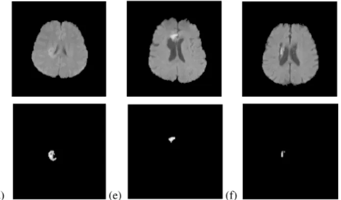 Fig. 6 Hyperintense lesions and their segmentation results: (a) acute  infarction, (b) haemorrhage, (c) abscess, (d) tumour, (e) acute infarction,  