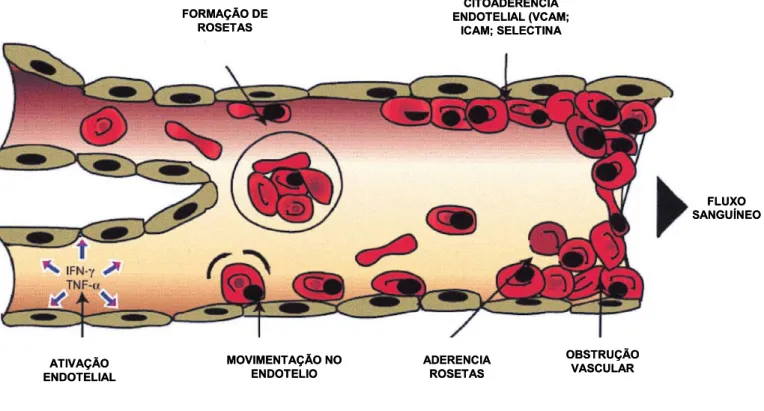 Figura 3: Mecanismo de citoaderência de eritrócitos parasitados na  microvasculatura cerebral, levando a obstrução do fluxo sanguíneo no quadro de  malária cerebral