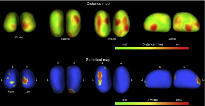 Fig. 3. Results of the shape analysis of thalami. The results are displayed in two maps
