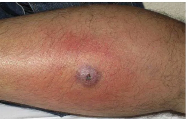 Figura 5: Manifestação clínica das infecções   cutâneas por S. aureus.  