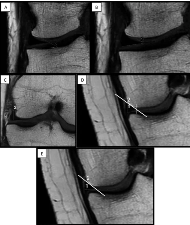 Fig 2. A-E. The central slice of a coronal MRI imaging of the knee focused on lateral compartment: A) meniscus-bone angle, B) meniscus-cartilage angle, C) meniscus-cartilage height, D) slope A, E) slope angle.