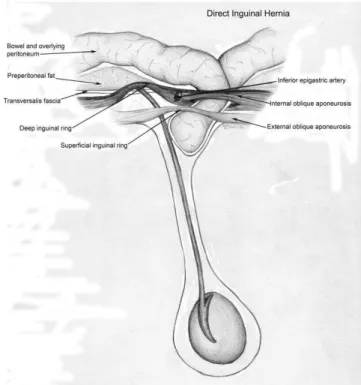 Figure 3.  Indirect Inguinal Hernia.  By definition, the hernia enters  the inguinal canal through the internal (deep) inguinal ring, lateral  to the epigastric vessels