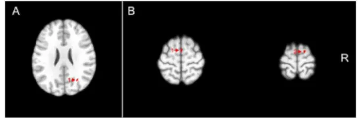 Figure 1. Voxel clusters of relatively reduced gray matter (A) and increased gray matter (B) in attention-deficit/hyperactivity disorder subjects compared to healthy controls are shown in red, overlaid on transaxial sections from a reference brain spatiall