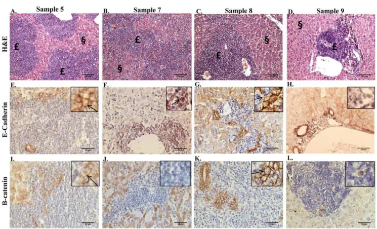 Figure 5. Metastatic profile of bone marrow transplantation experiments. A. Graphical representation of the metastatic burden determined for the lungs, kidneys, and livers analyzed by H+E staining from samples 5–9 BM