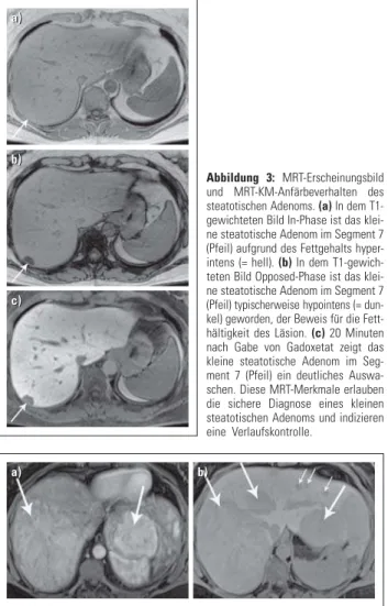 Abbildung 4: MRT-KM-Anfärbeverhalten des inflammatorischen Adenoms. (a)  In dem T1-gewichteten Bild in der arteriellen Phase nach Gabe von Gadoxetat  kom-men mehrere, bis &gt; 5 cm messende, hypervaskularisierte Raumforderungen in beiden Leberlappen zur Da