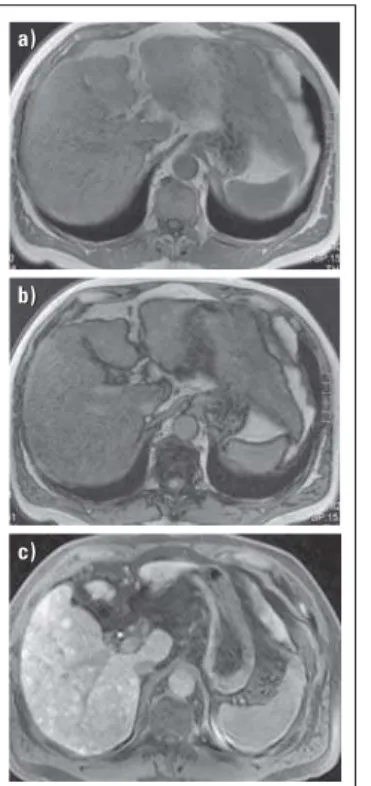 Abbildung 10: Diagnose von Steatose, Fibrose und Zirrhose. (a) In dem  T1-ge-wichteten MRT-Bild In-Phase zeigt sich ein inhomogenes Signal der Leber,  hin-weisend auf eine diffuse  Parenchym-erkrankung