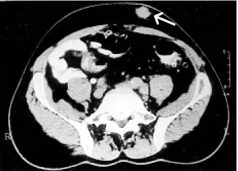 Figure 1 - Abdominal CT shows subcutaneous nodule in the left anterior wall.