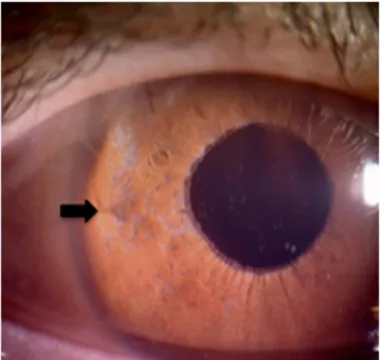 Fig 3. Postoperative photograph of a retropupillary fixated iris-claw lens after re-enclavation