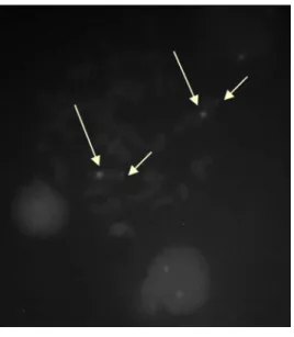 Figure 1 demonstrates a metaphase submitted to the FISH technique, which shows the  normal expected result, that is, two centromeric signals which identify chromosome 2 and two  subtelomeric signals that speciically identify the 2q37 region.