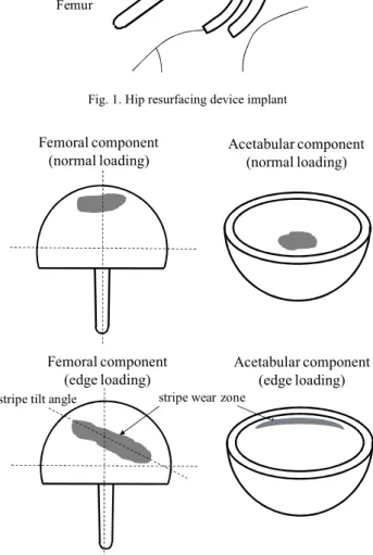 Fig. 2. Hip resurfacing device normal and edge loading wear