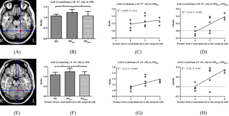 Fig 4. Brain areas which showed significant ΔReHo in PD post versus PD pre and correlated with tremor